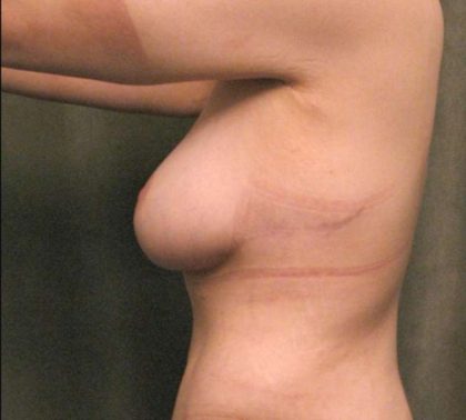 Breast Lift Before & After Patient #1257