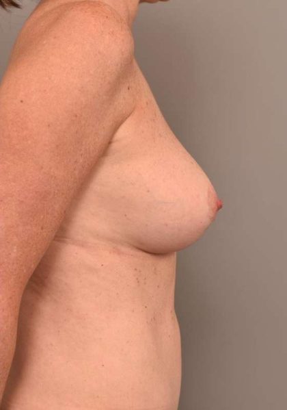 Breast Lift Before & After Patient #1270