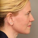 Facelift Before & After Patient #1371
