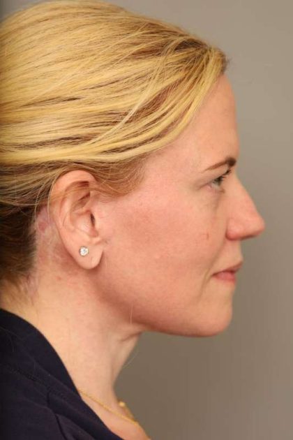 Facelift Before & After Patient #1371