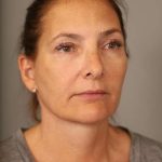 Facelift Before & After Patient #1380