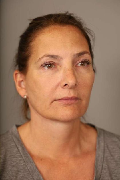 Facelift Before & After Patient #1380