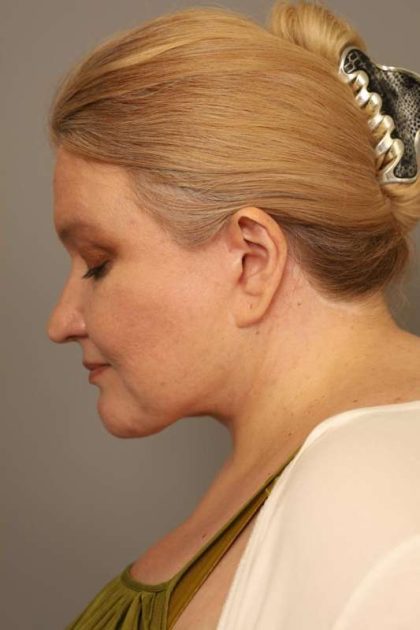 Facelift Before & After Patient #1389