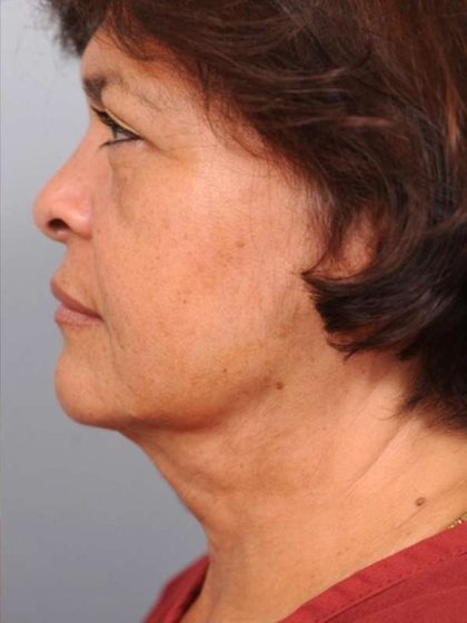 Facelift Before & After Patient #1399