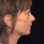Facelift Before & After Patient #1411