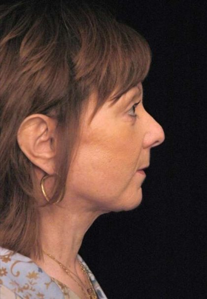 Facelift Before & After Patient #1411