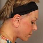Facelift Before & After Patient #1418