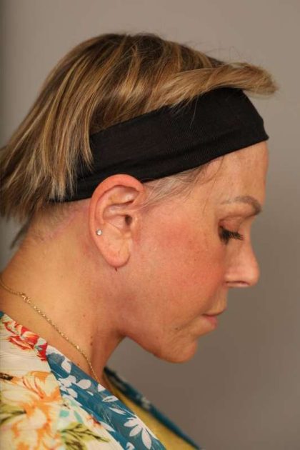 Facelift Before & After Patient #1418