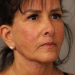 Facelift Before & After Patient #1427