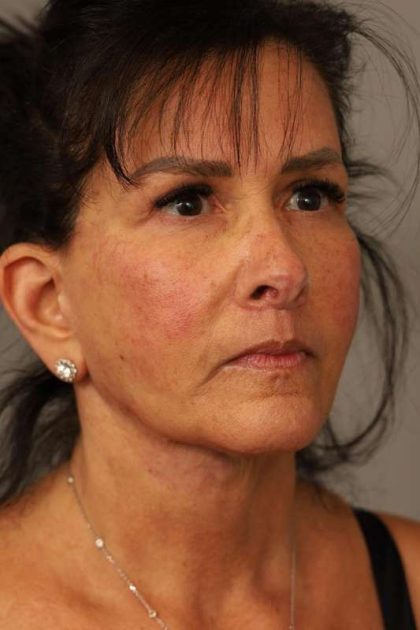 Facelift Before & After Patient #1427