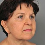Facelift Before & After Patient #1436