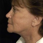 Facelift Before & After Patient #1443