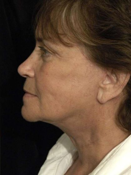 Facelift Before & After Patient #1443