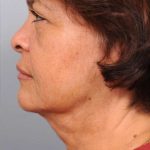 Naturalift&trade; Mini Facelift Before & After Patient #1452