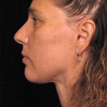 Naturalift&trade; Mini Facelift Before & After Patient #1464