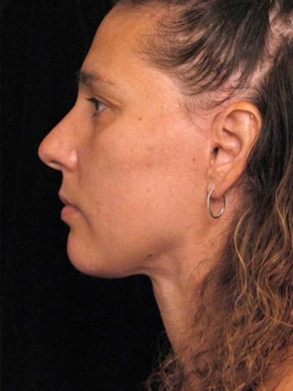 Naturalift™ Mini Facelift Before & After Patient #1464