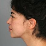 Naturalift&trade; Mini Facelift Before & After Patient #1474