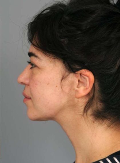 Naturalift™ Mini Facelift Before & After Patient #1474