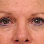 Eyelid Surgery Before & After Patient #1481