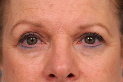 Eyelid Surgery Before & After Patient #1481