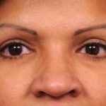 Eyelid Surgery Before & After Patient #1490