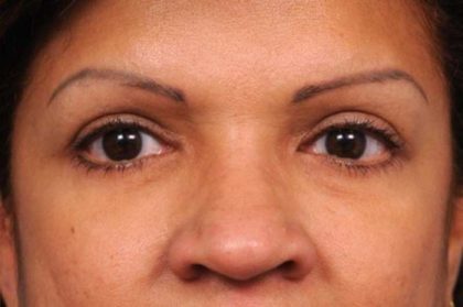 Eyelid Surgery Before & After Patient #1490