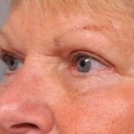 Eyelid Surgery Before & After Patient #1504