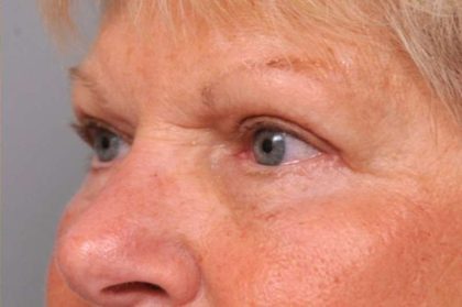 Eyelid Surgery Before & After Patient #1504
