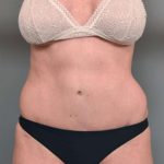 Tummy Tuck Before & After Patient #319