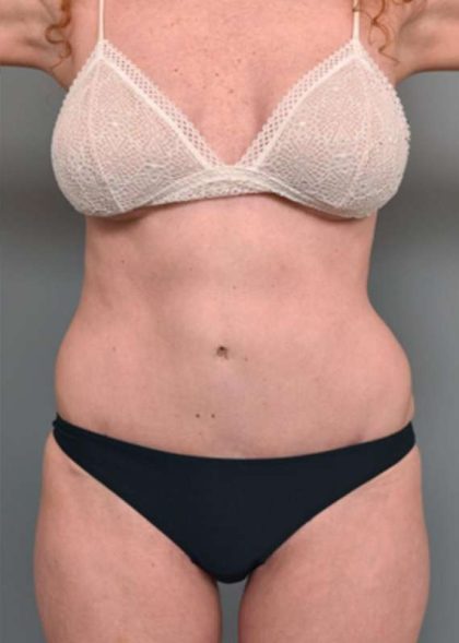 Tummy Tuck Before & After Patient #319