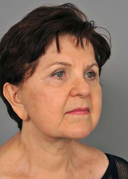 Eyelid Surgery Before & After Patient #1540