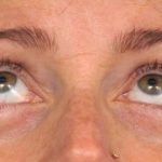 Eyelid Surgery Before & After Patient #1550