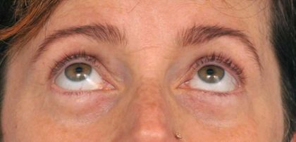 Eyelid Surgery Before & After Patient #1550