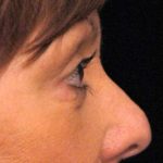 Eyelid Surgery Before & After Patient #1557
