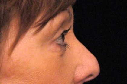 Eyelid Surgery Before & After Patient #1557