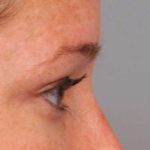 Eyelid Surgery Before & After Patient #1565