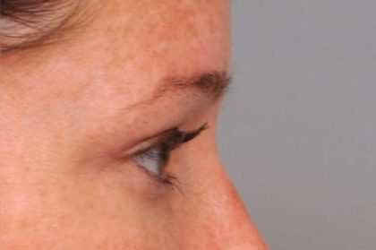 Eyelid Surgery Before & After Patient #1565