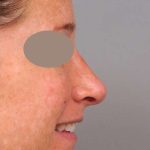 Rhinoplasty Before & After Patient #1572