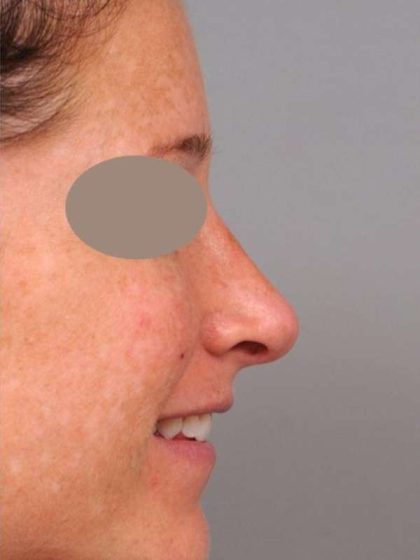 Rhinoplasty Before & After Patient #1572