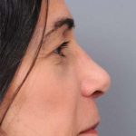Rhinoplasty Before & After Patient #1586
