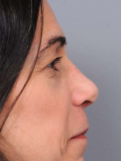 Rhinoplasty Before & After Patient #1586