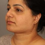 Neck Lift (Traditional) Before & After Patient #1605