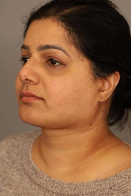 Neck Lift (Traditional) Before & After Patient #1605