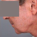 Neck Lift (Traditional) Before & After Patient #1612