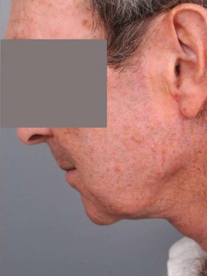 Neck Lift (Traditional) Before & After Patient #1612