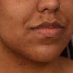 Neck Lift (Traditional) Before & After Patient #1621