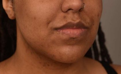 Neck Lift (Traditional) Before & After Patient #1621