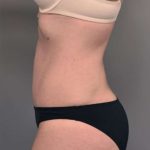 Tummy Tuck Before & After Patient #329