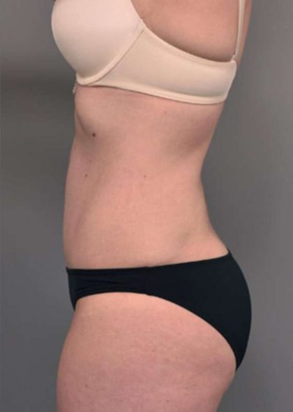 Tummy Tuck Before & After Patient #329