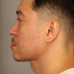 Mini Neck Lift (Single Incision) Before & After Patient #1630